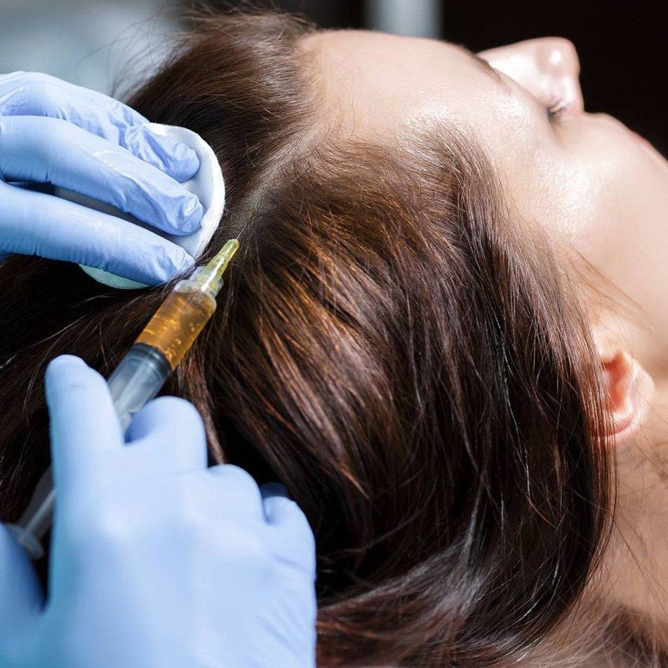 A close-up of a platelet-rich plasma treatment in progress: gloved hands part the hair at the crown and guide a fine syringe of golden plasma into the scalp.